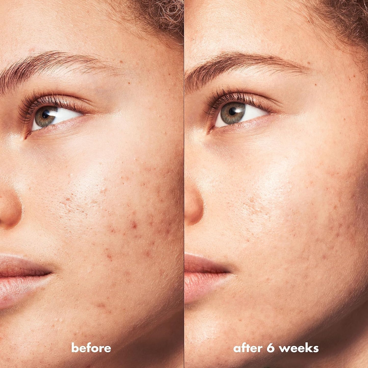 e.l.f. SKIN Blemish Breakthrough Acne Clarifying Cleanser, 3.889 fl oz